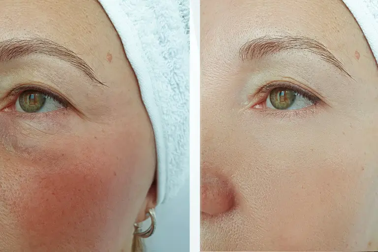 laser-vasculaire-avant-apres