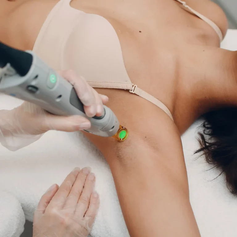 epilation laser aisselle